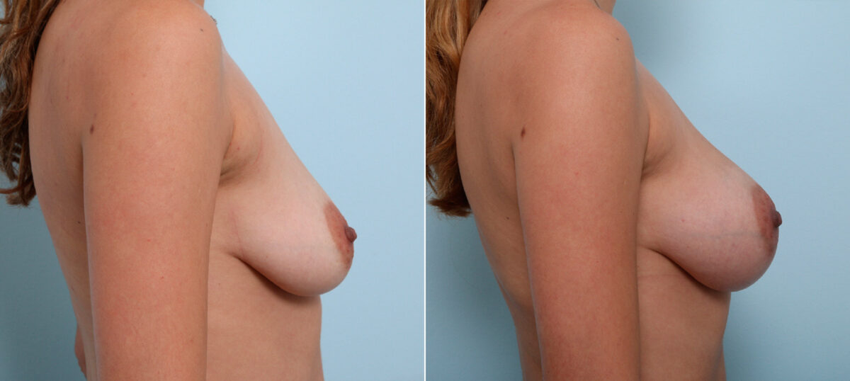 Breast Augmentation before and after photos in Houston, TX, Patient 42455