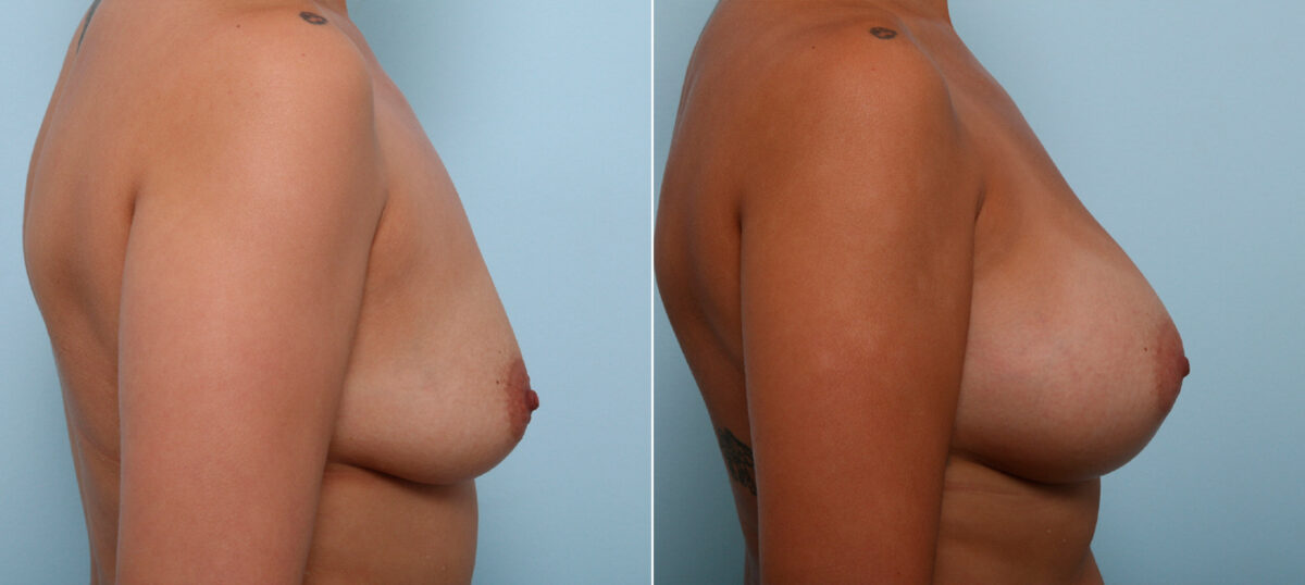 Breast Augmentation before and after photos in Houston, TX, Patient 42472