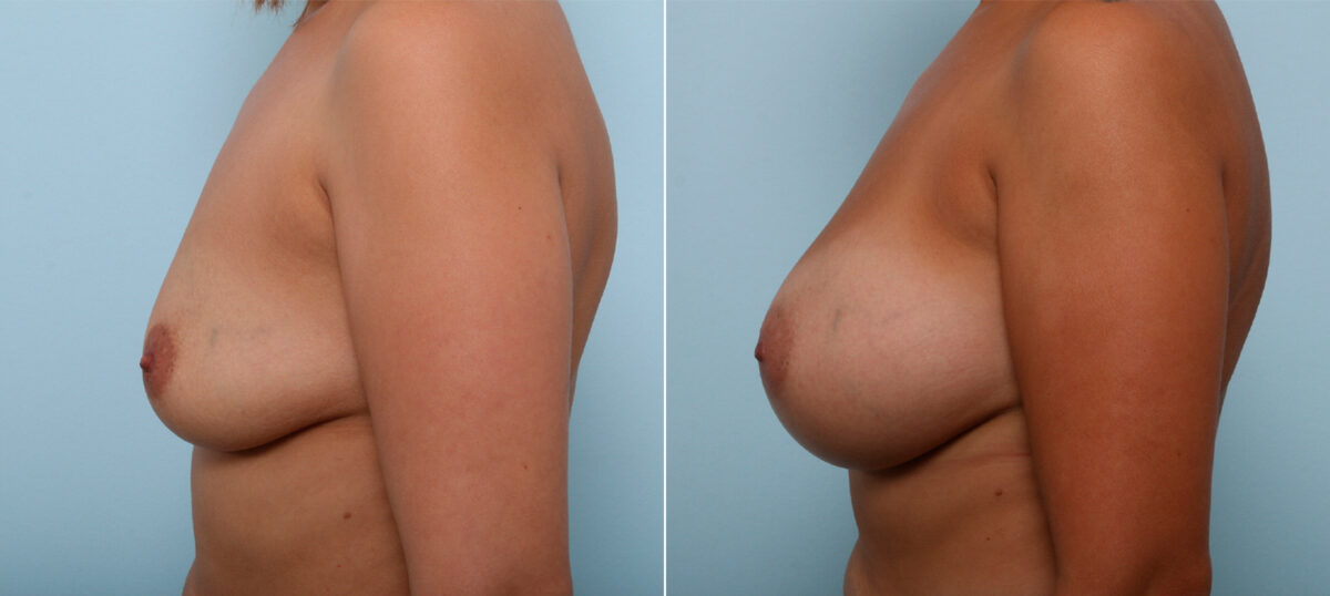 Breast Augmentation before and after photos in Houston, TX, Patient 42472