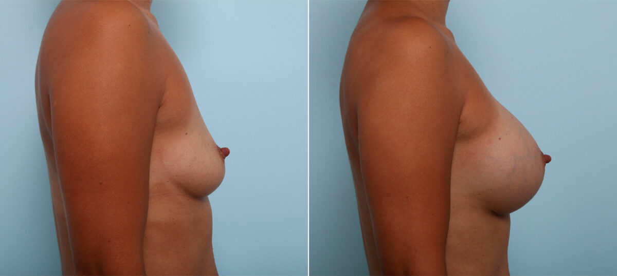 Breast Augmentation before and after photos in Houston, TX, Patient 42493