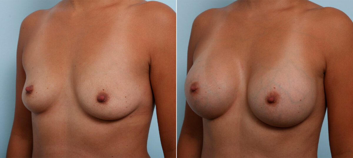 Breast Augmentation before and after photos in Houston, TX, Patient 42493
