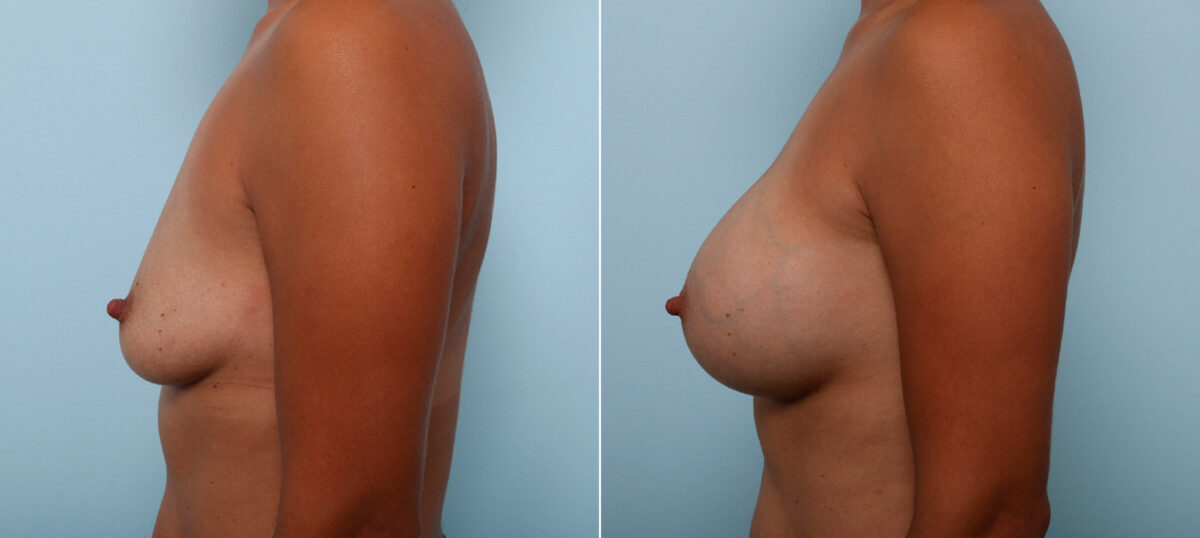 Breast Augmentation before and after photos in Houston, TX, Patient 42493