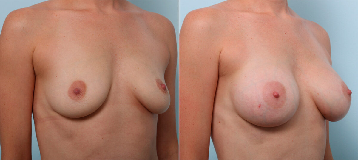 Breast Augmentation before and after photos in Houston, TX, Patient 42514