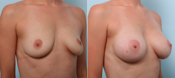 Breast Augmentation before and after photos in Houston, TX, Patient 42514