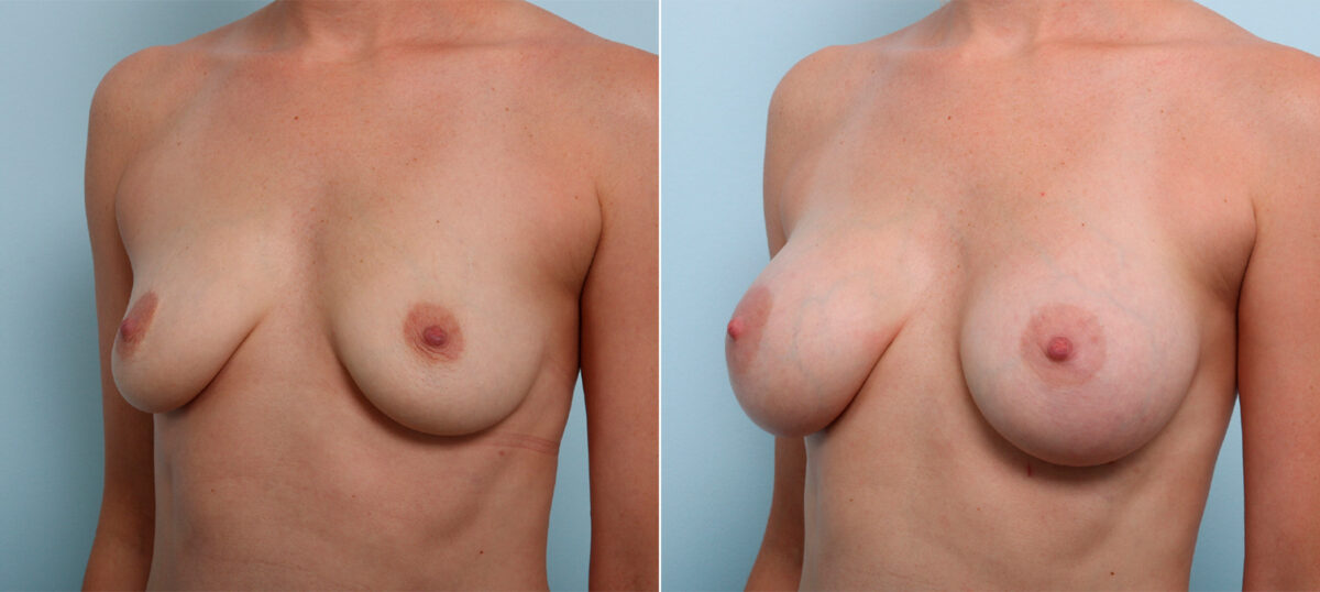 Breast Augmentation before and after photos in Houston, TX, Patient 42514