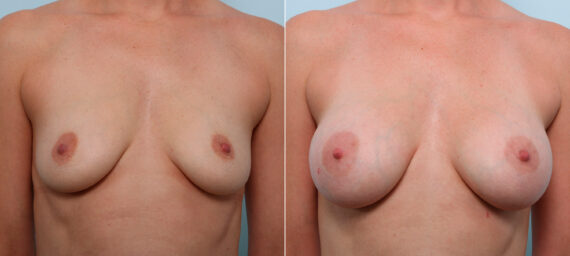 Breast Augmentation before and after photos in Houston, TX, Patient 42514