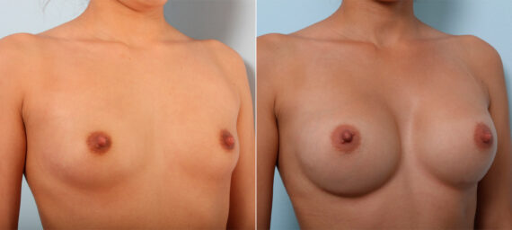 Breast Augmentation before and after photos in Houston, TX, Patient 42535