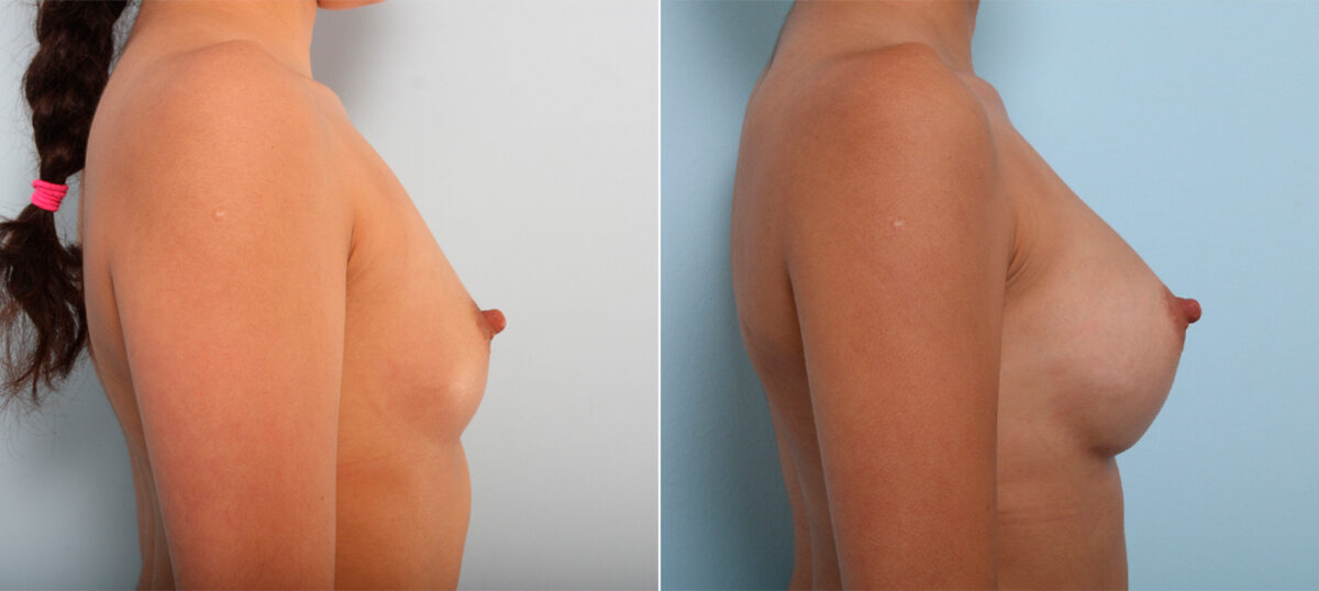 Breast Augmentation before and after photos in Houston, TX, Patient 42535