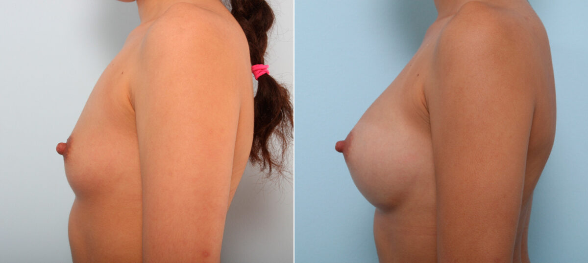 Breast Augmentation before and after photos in Houston, TX, Patient 42535