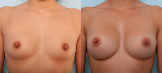 Breast Augmentation before and after photos in Houston, TX, Patient 42535