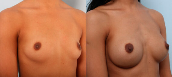 Breast Augmentation before and after photos in Houston, TX, Patient 42556