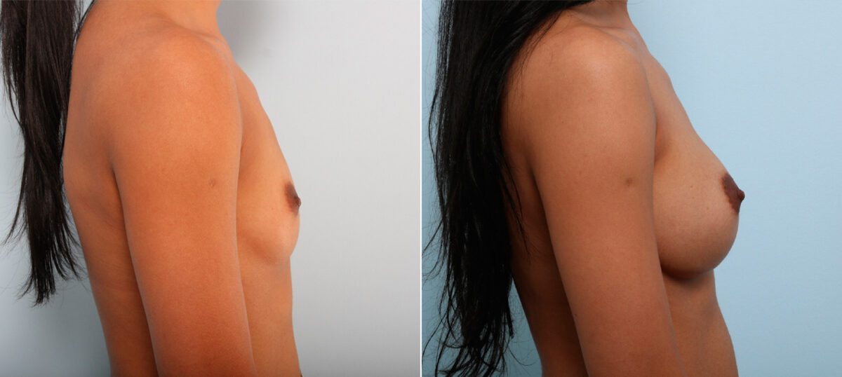Breast Augmentation before and after photos in Houston, TX, Patient 42556