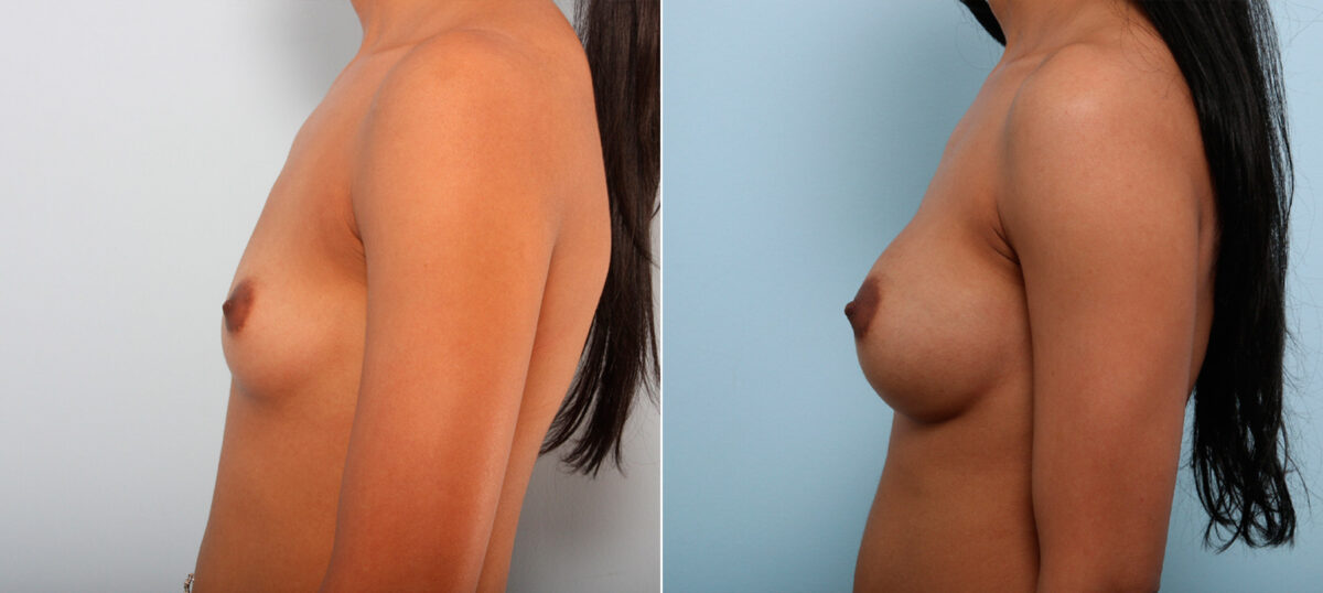 Breast Augmentation before and after photos in Houston, TX, Patient 42556