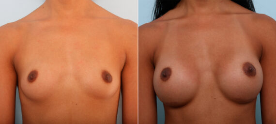 Breast Augmentation before and after photos in Houston, TX, Patient 42556