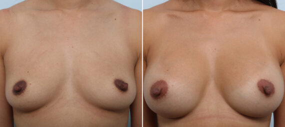 Breast Augmentation before and after photos in Houston, TX