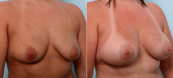 Breast Augmentation before and after photos in Houston, TX, Patient 43267