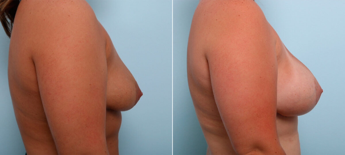 Breast Augmentation before and after photos in Houston, TX, Patient 43267