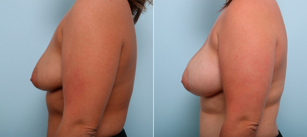 Breast Augmentation before and after photos in Houston, TX, Patient 43267