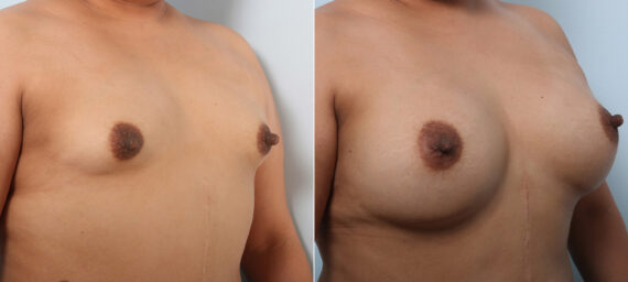 Breast Augmentation before and after photos in Houston, TX, Patient 43286
