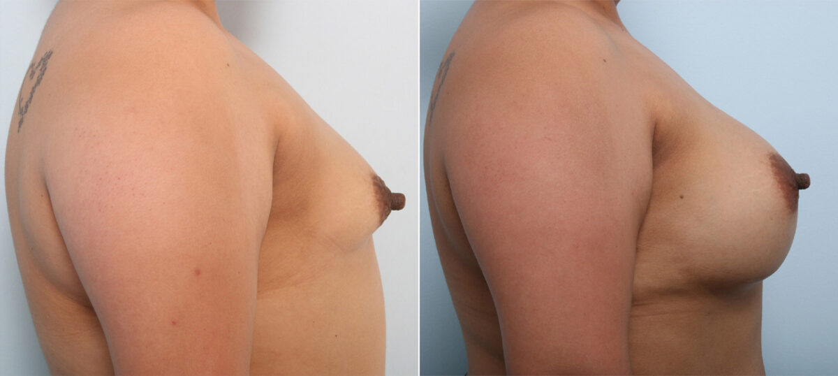 Breast Augmentation before and after photos in Houston, TX, Patient 43286