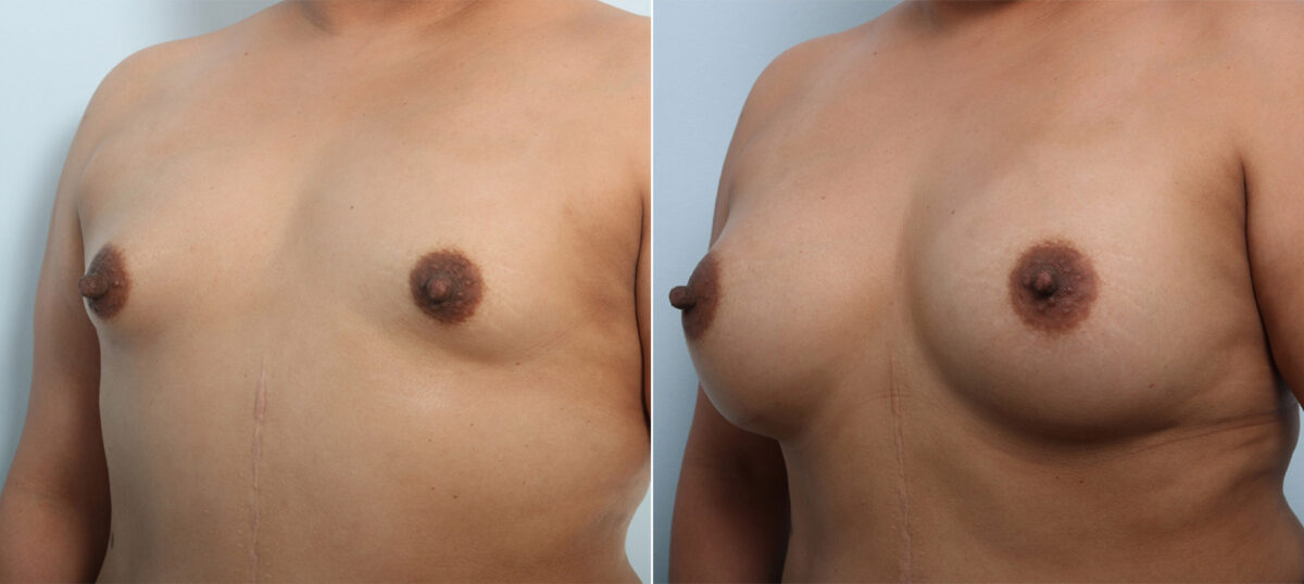 Breast Augmentation before and after photos in Houston, TX, Patient 43286