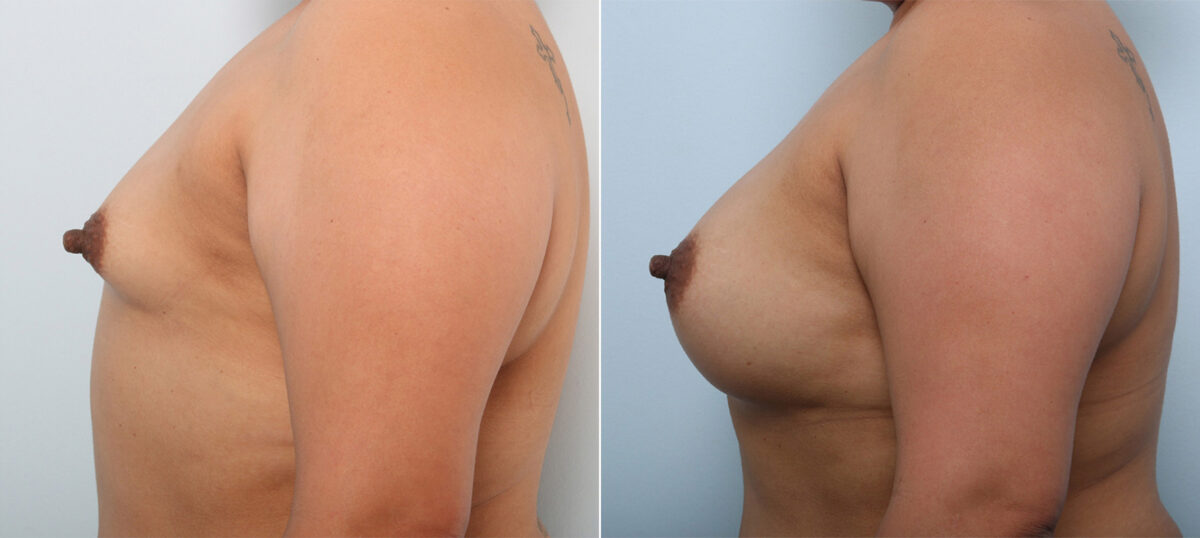 Breast Augmentation before and after photos in Houston, TX, Patient 43286