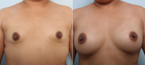 Breast Augmentation before and after photos in Houston, TX, Patient 43286