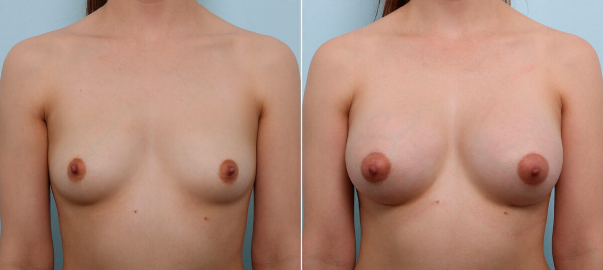 Breast Augmentation before and after photos in Houston, TX, Patient 43513