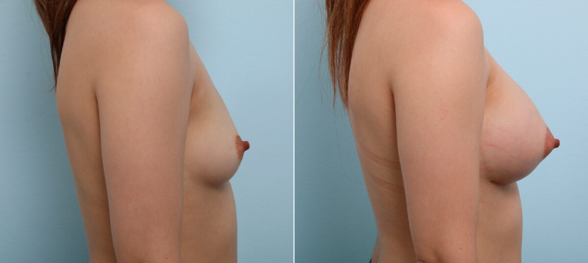 Breast Augmentation before and after photos in Houston, TX, Patient 43513