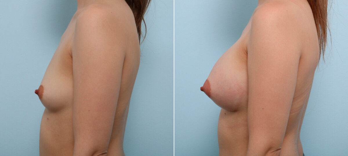 Breast Augmentation before and after photos in Houston, TX, Patient 43513