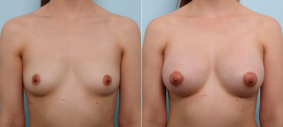 Breast Augmentation before and after photos in Houston, TX, Patient 43513