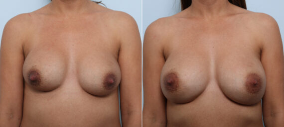 Breast Implant Exchange before and after photos in Houston, TX