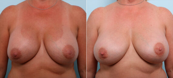 Breast Implant Exchange before and after photos in Houston, TX