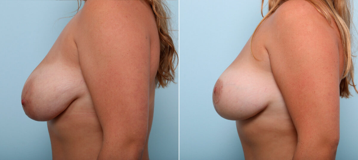 Breast Lift before and after photos in Houston, TX, Patient 54629