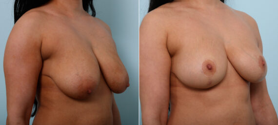 Breast Lift before and after photos in Houston, TX, Patient 54645