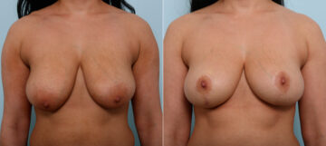Breast Lift before and after photos in Houston, TX, Patient 54645