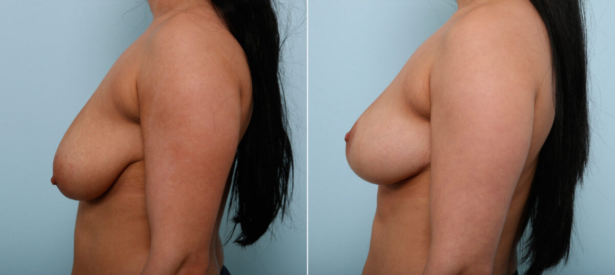 Breast Lift before and after photos in Houston, TX, Patient 54645