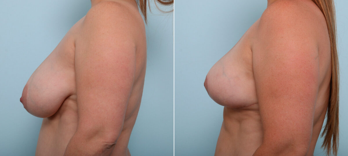 Breast Lift before and after photos in Houston, TX, Patient 54679