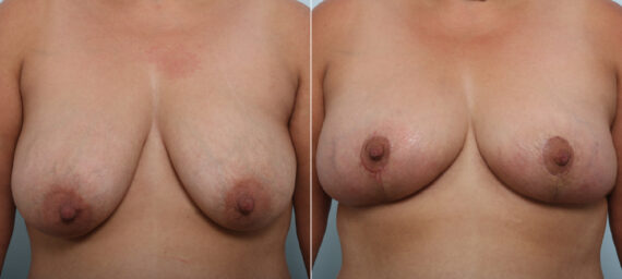Breast Lift before and after photos in Houston, TX, Patient 54718