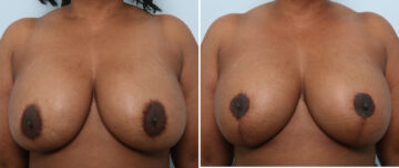 Breast Lift with Augmentation before and after photos in Houston, TX, Patient 57592