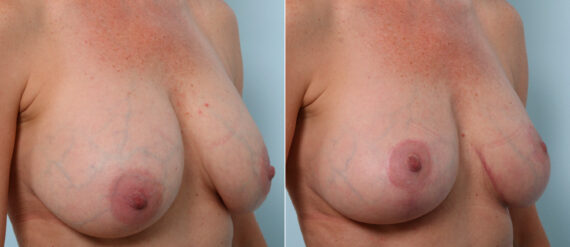 Breast Lift before and after photos in Houston, TX, Patient 57619