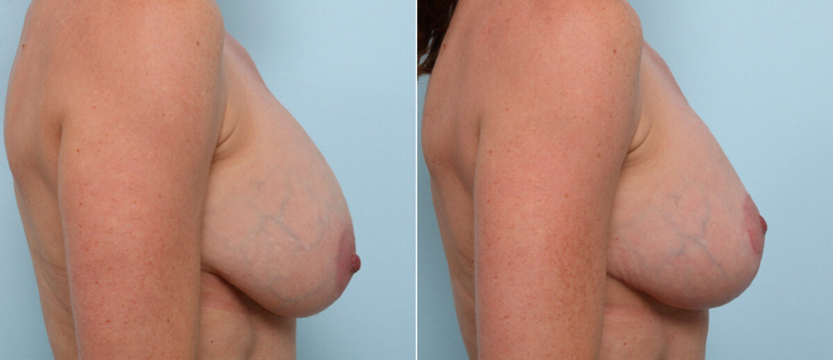 Breast Lift before and after photos in Houston, TX, Patient 57619