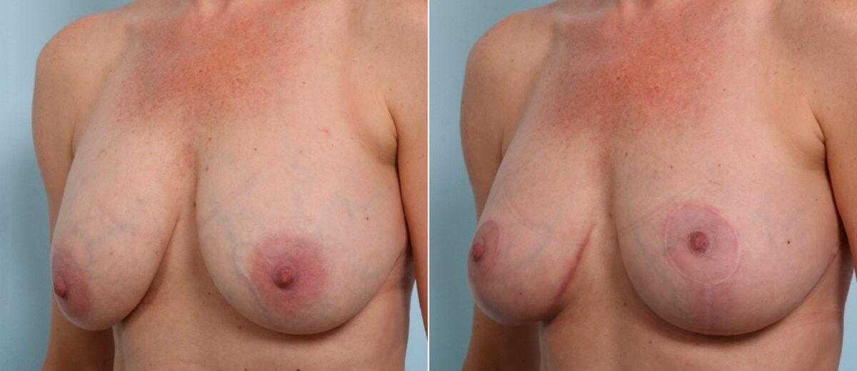 Breast Lift before and after photos in Houston, TX, Patient 57619