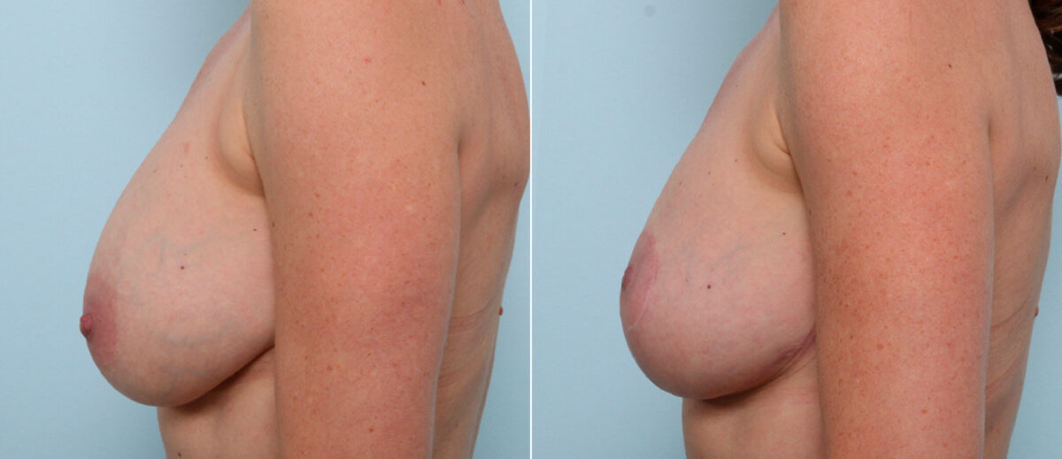 Breast Lift before and after photos in Houston, TX, Patient 57619