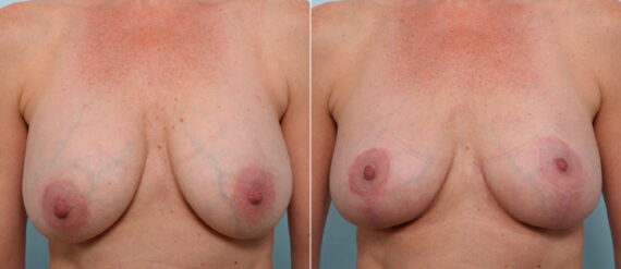 Breast Lift before and after photos in Houston, TX, Patient 57619