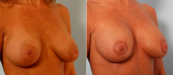 Breast Lift with Augmentation before and after photos in Houston, TX, Patient 57636