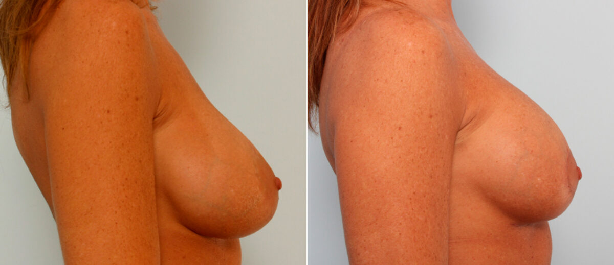 Breast Lift with Augmentation before and after photos in Houston, TX, Patient 57636