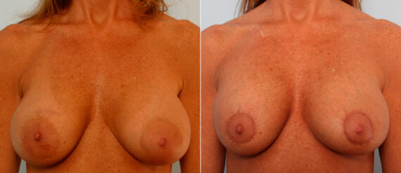 Breast Lift with Augmentation before and after photos in Houston, TX, Patient 57636