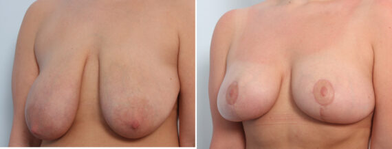 Breast Lift before and after photos in Houston, TX, Patient 57686