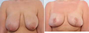Breast Lift before and after photos in Houston, TX, Patient 57686